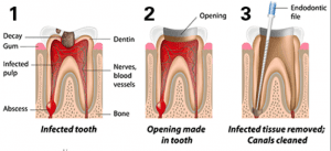 rootcanal1