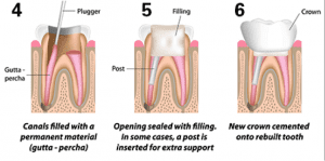 rootcanal2