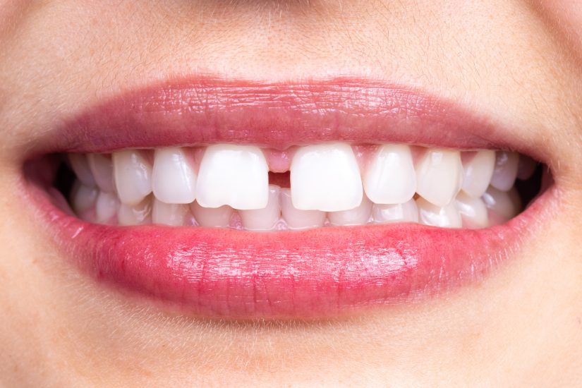 gap tooth