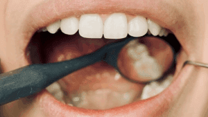 wisdom tooth crowding Tindale Dental Centre