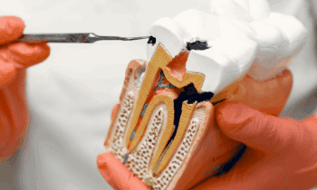 tooth decay prevention tips from Tindale Dental Centre