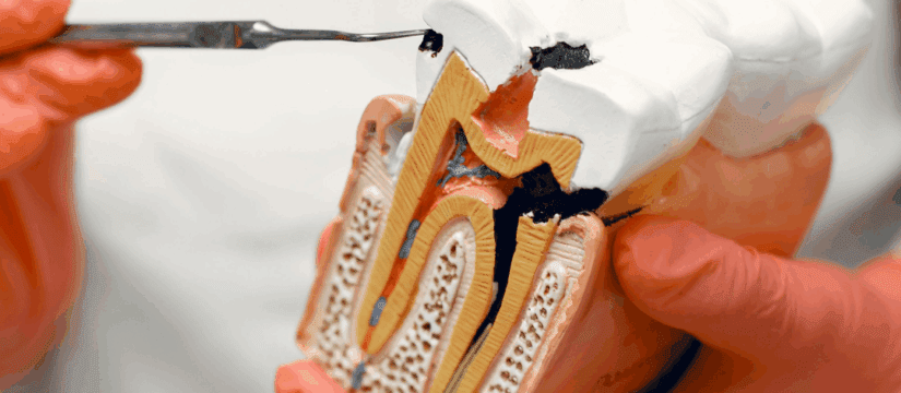 tooth decay prevention tips from Tindale Dental Centre