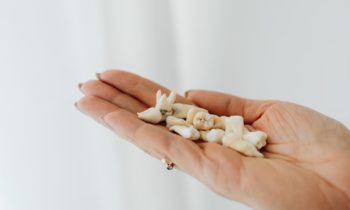tooth extraction