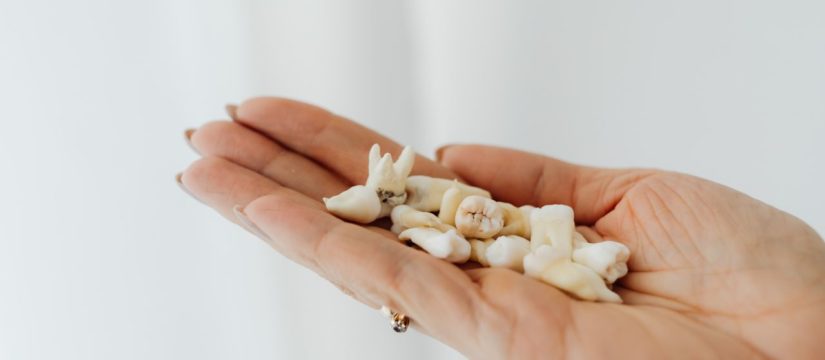 tooth extraction