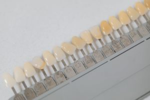 veneers