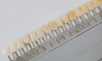 veneers