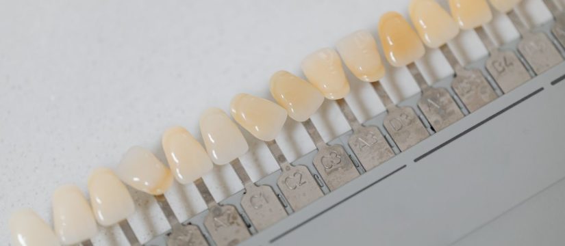 veneers