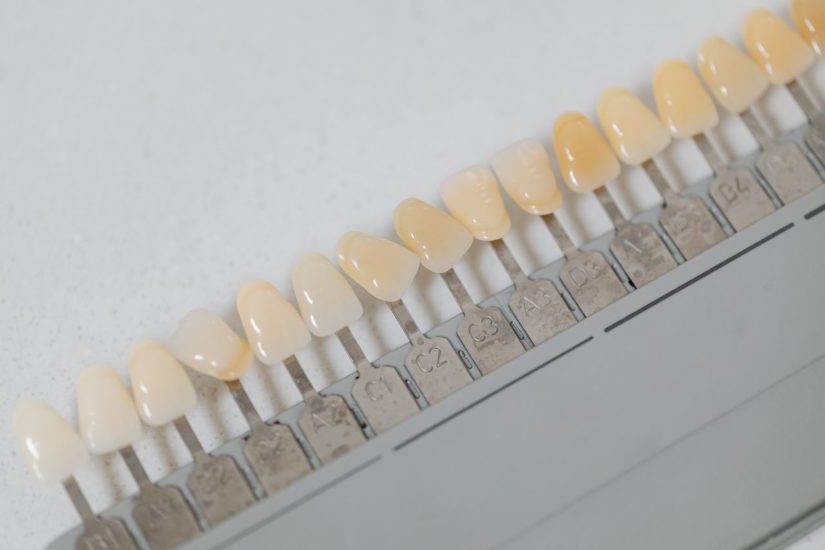 veneers